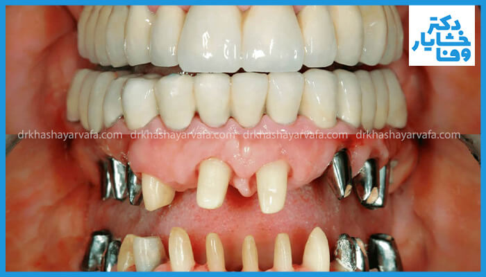 نمای نزدیک از داخل دهان بیمار که در حال دریافت درمان دندانپزشکی است. در این تصویر، پروتزهای موقت یا آماده‌سازی‌های دندانی در فک بالا و پایین، از جمله پایه‌های دندان‌های آماده‌شده برای روکش و همچنین برخی روکش‌های فلزی موقت یا زیرساخت‌های فلزی قدیمی در طرفین، و ساختار لثه دیده می‌شود. این تصویر به نظر می‌رسد مرحله‌ای از کار ایمپلنت یا پروتزهای ثابت دندانی را نشان می‌دهد. لوگوی "دکتر خشایار وفا" نیز در گوشه سمت راست بالا قرار دارد.