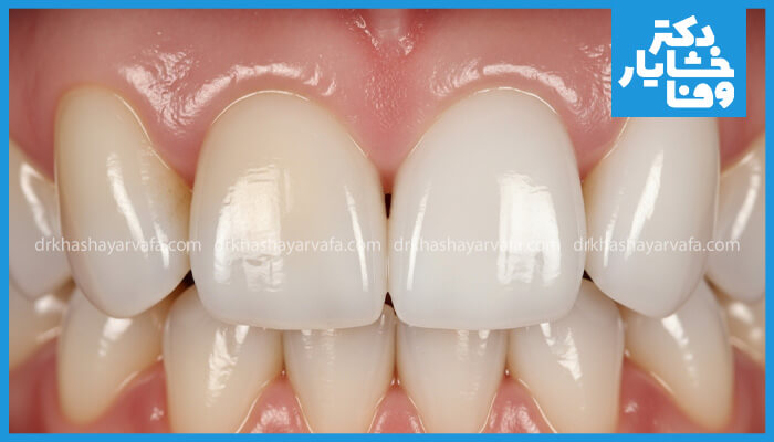 نمای بسیار نزدیکی از دندانهای جلویی بالا و پایین پس از یک عمل زیبایی دندان (مانند ونیر یا باندینگ)، که رنگ سفید روشن و یکنواخت و شکل بینقص دندانهای پیشین مرکزی را نشان میدهد. لثهها سالم به نظر میرسند.