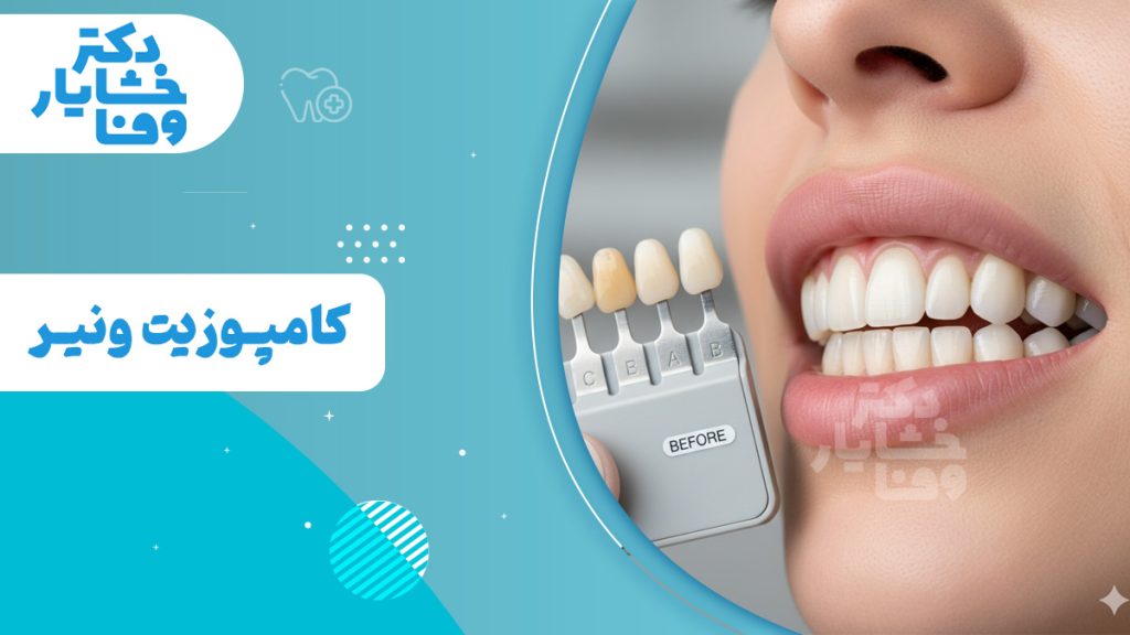 نمای نزدیکی از دهان یک فرد با لبخندی سفید و درخشان که با راهنمای رنگ دندان برای تطبیق ونیر کامپوزیت مقایسه می‌شود. راهنمای رنگ، چندین رنگ دندان، از جمله رنگ زرد طبیعی و گزینه‌های سفیدتر با برچسب‌های A، B، C و E را نشان می‌دهد که کلمه "قبل" روی راهنما قابل مشاهده است. متن تصویر به زبان فارسی است و به "دکتر خشایار وفا" (دکتر خشایار وفا) و "کامپوزیت ونیر" (ونیر کامپوزیت) اشاره می‌کند.