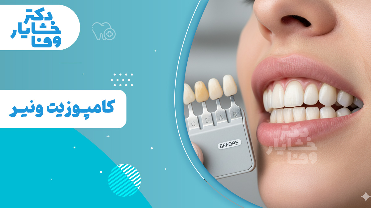 نمای نزدیکی از دهان یک فرد با لبخندی سفید و درخشان که با راهنمای رنگ دندان برای تطبیق ونیر کامپوزیت مقایسه میشود. راهنمای رنگ، چندین رنگ دندان، از جمله رنگ زرد طبیعی و گزینههای سفیدتر با برچسبهای A، B، C و E را نشان میدهد که کلمه "قبل" روی راهنما قابل مشاهده است. متن تصویر به زبان فارسی است و به "دکتر خشایار وفا" (دکتر خشایار وفا) و "کامپوزیت ونیر" (ونیر کامپوزیت) اشاره میکند.