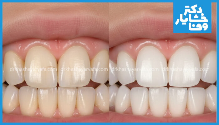 این تصویر نمونه‌ای از لمینت دندان را نشان می‌دهد. سمت راست دندان‌ها پس از درمان، سفیدتر و هموارتر هستند، در حالی که سمت چپ وضعیت اولیه دندان‌ها را نشان می‌دهد که دارای رنگ ناهمگون و ترک‌های سطحی هستند. این عکس تأثیر لمینت را در زیبایی و اصلاح لبخند به خوبی نمایش می‌دهد.