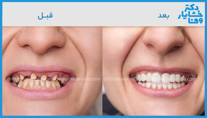 تصویر مقایسه‌ای "قبل و بعد" از لبخند یک بیمار که تغییرات دندان‌ها را نشان می‌دهد. در بخش "قبل"، دندان‌ها دارای بهم‌ریختگی، تغییر رنگ و پوسیدگی‌های قابل مشاهده هستند. در بخش "بعد"، همان لبخند با دندان‌هایی سفید، صاف و ترمیم‌شده دیده می‌شود که نتیجه درمان زیبایی دندان است. لوگوی "دکتر خشایار وفا" در بالای تصویر قابل مشاهده است.
