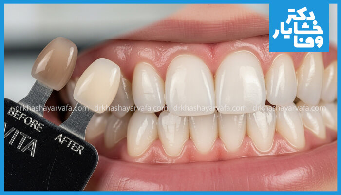 نمای نزدیکی از دندانهای یک فرد، که لبخندی روشن سفید را نشان میدهد. یک راهنمای رنگ VITA در پیش زمینه قرار دارد که رنگ تیرهتر «قبل» دندان (بالا سمت چپ) و رنگ سفیدتر «بعد» را نشان میدهد که تغییر قابل توجهی را از رنگ اصلی دندان تا نتیجه نهایی نشان میدهد.