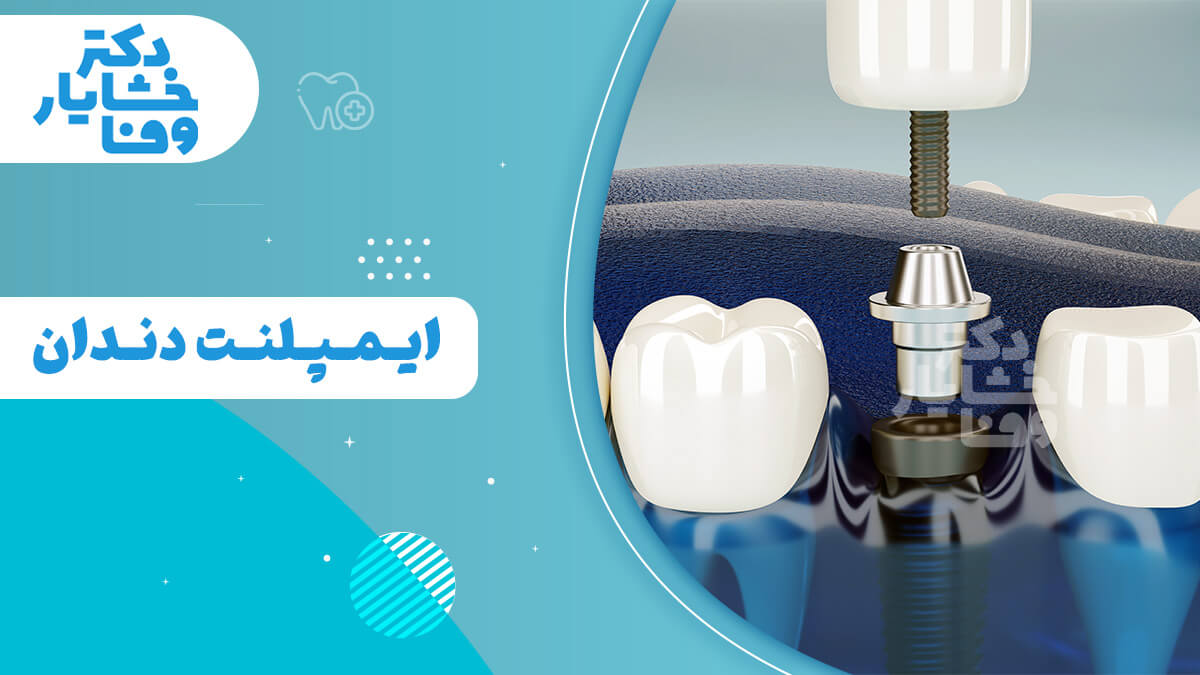 ایمپلنت دندان، ساختار ایمپلنت دندان، اجزای ایمپلنت دندان، دکتر خشایار وفا ایمپلنت