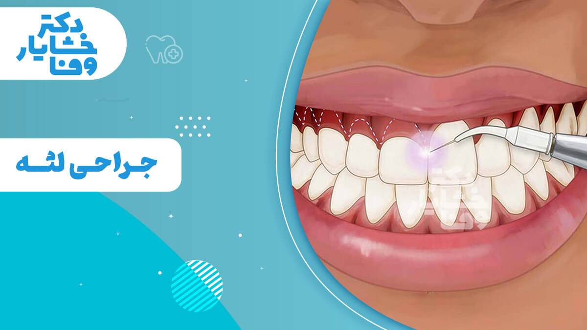 تصویر شاخص جراحی لثه (جینجیوکتومی یا جینجیوپلاستی) با دستگاه پیشرفته برای بهبود سلامت لثه و زیباسازی طرح لبخند.