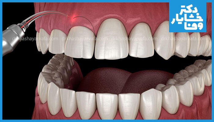 تصویر شماتیک استفاده از لیزر دندانپزشکی برای جراحی و اصلاح طرح لبخند یا درمان التهاب لثه با کمترین درد و خونریزی.