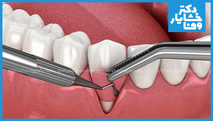 تصویر استفاده از ابزار دندانپزشکی برای انجام جرمگیری عمیق و تسطیح ریشه (Root Planing) به منظور درمان بیماریهای لثه و عفونت پریودنتال.