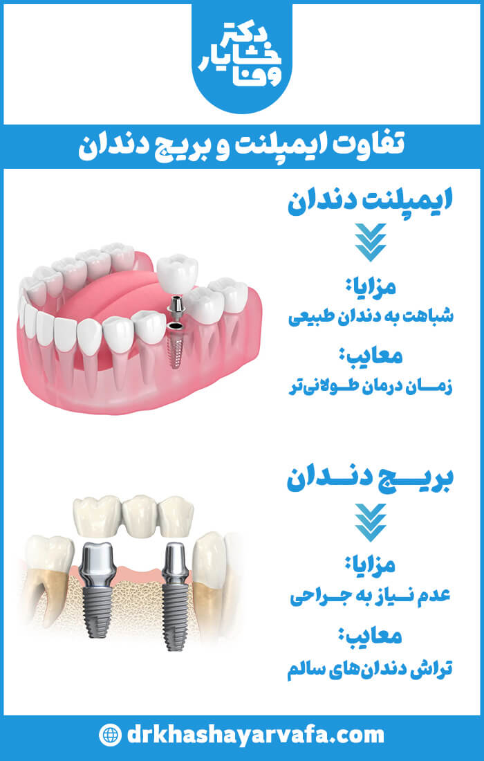 اینفوگرافیک مقایسه تفاوت ایمپلنت و بریج دندان. در بخش ایمپلنت، تصویر سه بُعدی یک ایمپلنت کاشته شده در فک و مزایای آن (شباهت به دندان طبیعی) و معایب آن (زمان درمان طولانی‌تر) نشان داده شده است. در بخش بریج دندان، تصویر یک بریج بر روی دو دندان تراشیده شده و مزایای آن (عدم نیاز به جراحی) و معایب آن (تراش دندان‌های سالم) ذکر شده است.