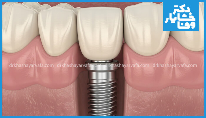 تصویر شماتیک از ساختار یک ایمپلنت دندان کامل شامل پایه، اباتمنت و تاج