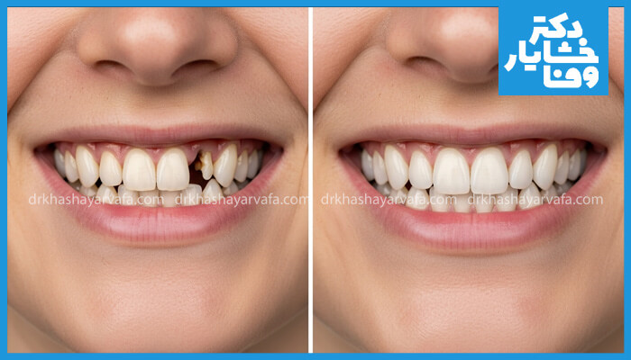 عکس قبل و بعد از کاشت ایمپلنت دندان که نتیجه موفقیت‌آمیز درمان را نشان می‌دهد