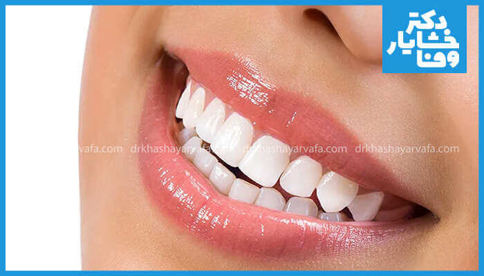نمای نزدیک از لبخند زیبا و اصلاح طرح لبخند با دندان‌های سفید و ردیف شده توسط کامپوزیت ونیر.