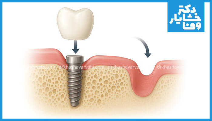 یک نمودار گرافیکی پزشکی که دو وضعیت را مقایسه می‌کند: ۱. ایمپلنت دندان کاشته‌شده در استخوان فک، که نشان‌دهنده سلامت و حفظ استخوان است (سمت چپ). ۲. ناحیه بدون دندان که تحلیل و فرورفتگی استخوان فک را به دلیل عدم تحریک نشان می‌دهد (سمت راست).