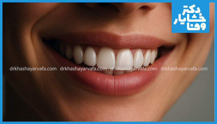 نمای نزدیک از لبخند طبیعی و بی‌نقص یک فرد، که دندان‌های سفید و ردیف را به زیبایی نشان می‌دهد. این تصویر بر نتیجه نهایی و زیبایی‌شناختی ایمپلنت دندان و حس طبیعی آن تاکید دارد.