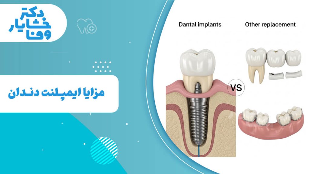 اینفوگرافیک مقایسه مزایای ایمپلنت دندان با سایر روش‌های جایگزینی دندان