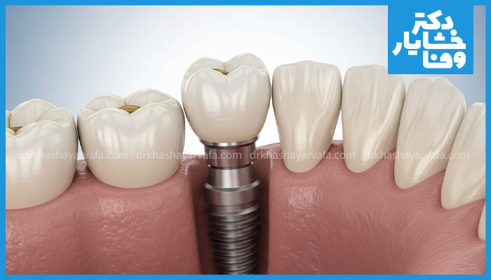 ساختار ایمپلنت دندان با نمایش فیکسچر (پیچ) کاشته شده در استخوان فک و تاج دندان مصنوعی روی آن.