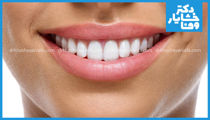 تصویری نزدیک از یک لبخند با دندان‌های سفید و مرتب که با ونیر کامپوزیت رزین زیبا شده‌اند.