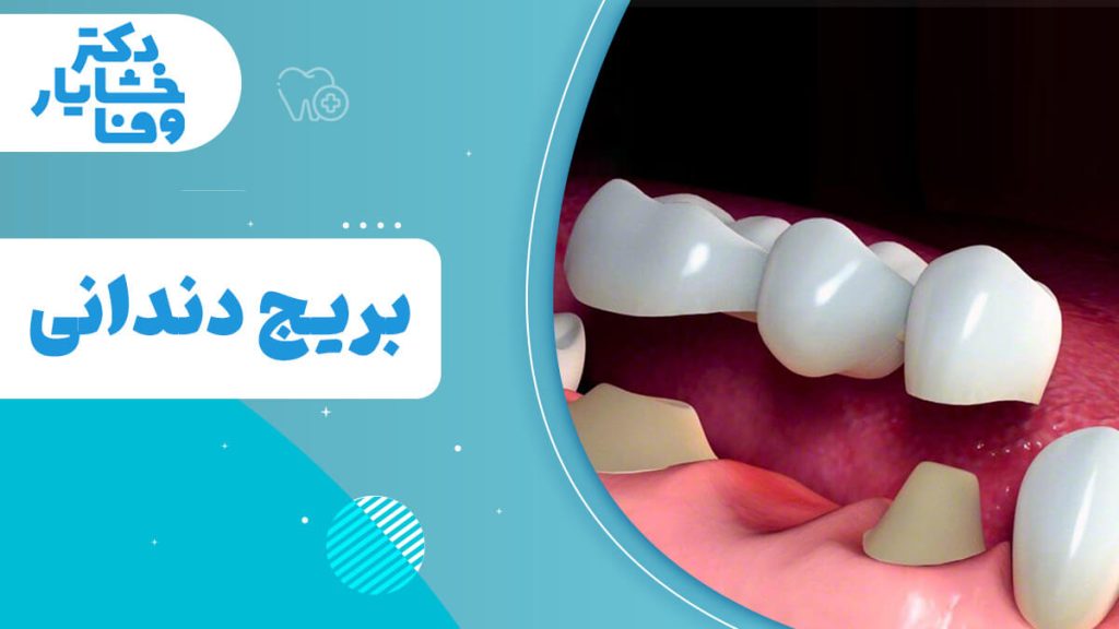 بریج دندانی