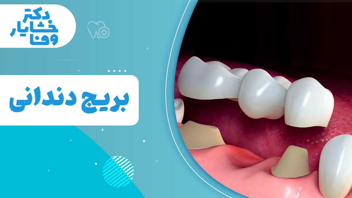 بریج دندانی