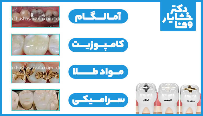 انواع مواد پر کننده دندان شامل آمالگام، کامپوزیت، مواد طلا و سرامیکی 