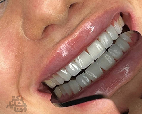 نمونه کار کامپوزیت دکتر خشایار وفا