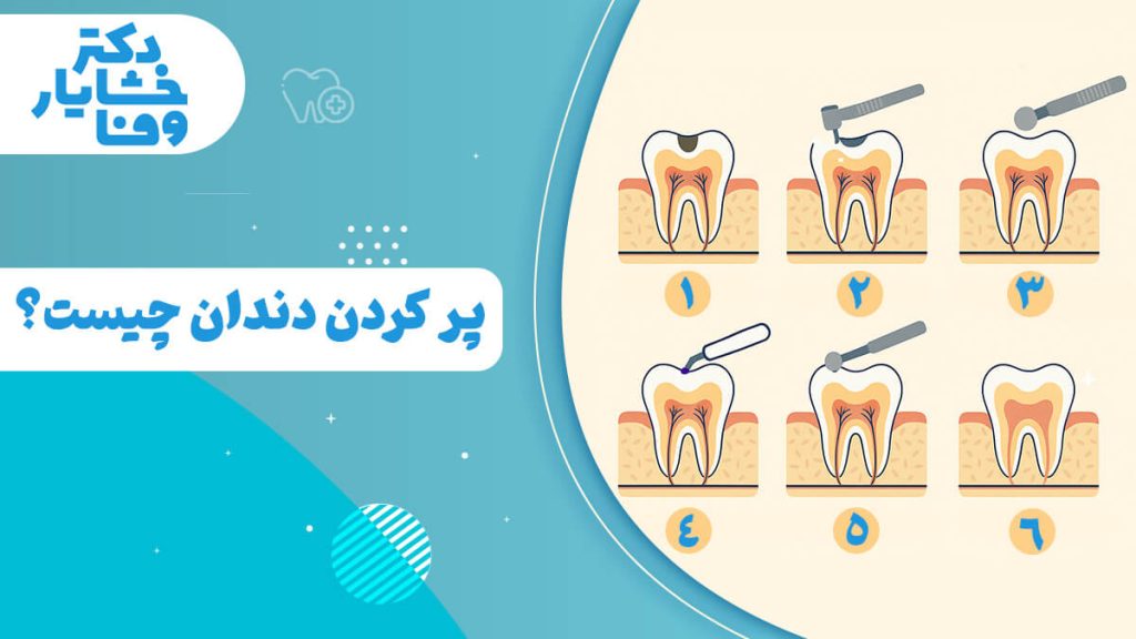 پر کردن دندان چیست؟ مراحل پر کردن دندان به صورت تصویری - دکتر خشایار وفا