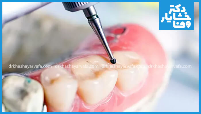 نمایی از انجام مراحل پر کردن دندان در کلینیک دکتر خشایار وفا 