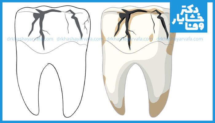 دو دندان که یکی با ترک‌خوردگی‌های سطحی و دیگری با نشانه‌های پوسیدگی و تغییر رنگ قهوه‌ای، که روند پیشرفت پوسیدگی دندان را نشان می‌دهد.