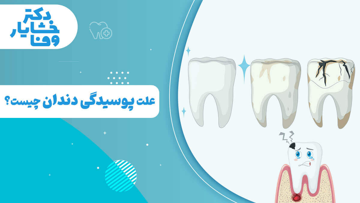 علت پوسیدگی دندان چیست؟ در این تصویر مراحل مختلف سلامت تا پوسیدگی دندان را به صورت کارتونی نشان می‌دهد، از دندان سالم تا دندان دچار پوسیدگی شدید و عفونت لثه است.