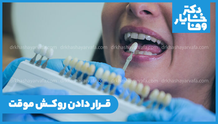 انتخاب رنگ روکش دندان موقت برای خانم