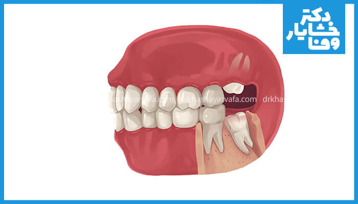 تصویر دندان عقل نهفته در فک پایین که نیاز به جراحی دارد 