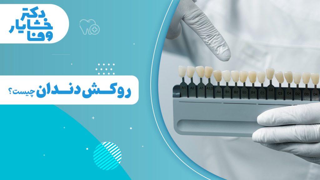 دندانپزشک در حال انتخاب رنگ مناسب برای روکش دندان با استفاده از راهنمای رنگ (shade guide) است.