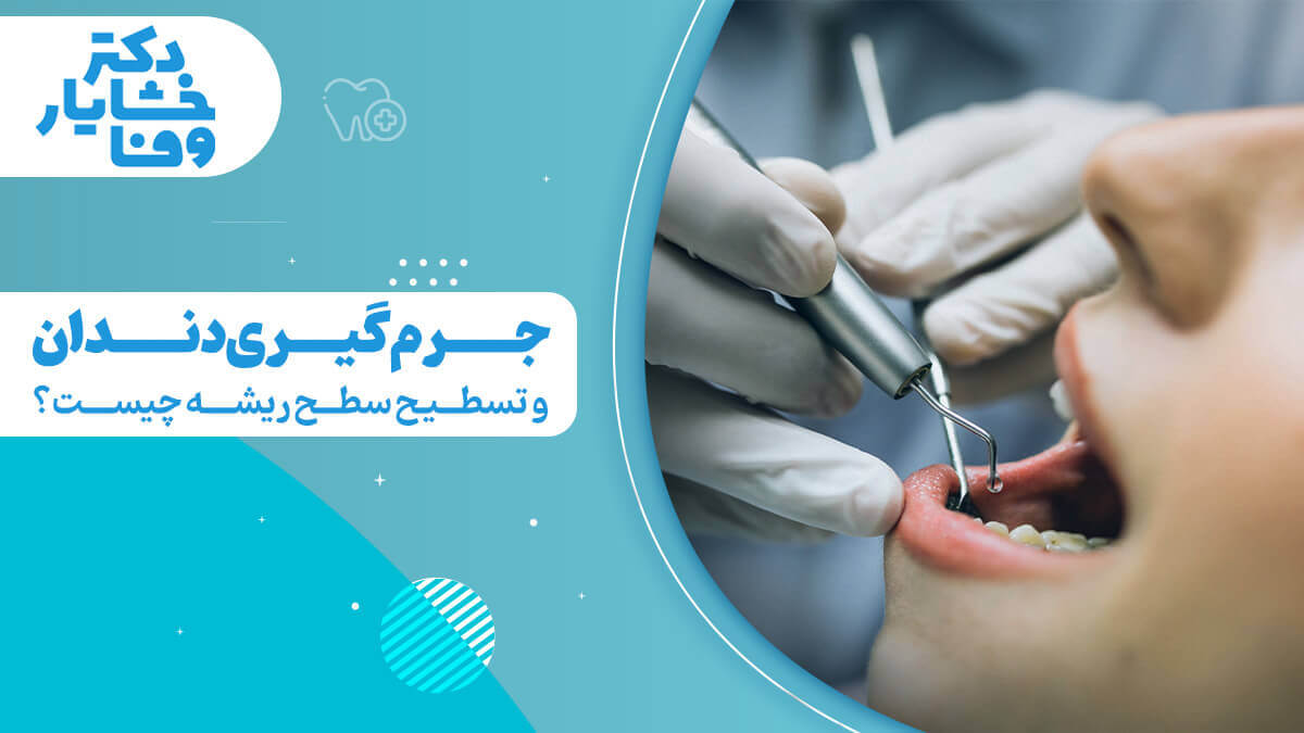 جرم‌گیری دندان و تسطیح سطح ریشه چیست؟ که یک دندانپزشک در حال انجام جرم‌گیری دندان روی دهان بیمار را با ابزار دندانپزشکی نشان می‌دهد.