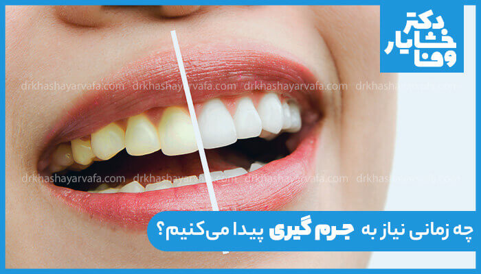 تصویر مقایسهای (قبل و بعد) از یک دهان با دندانهای زرد و جرمگرفته در یک طرف و دندانهای سفید و تمیز در طرف دیگر، با عنوان چه زمانی به جرمگیری نیاز پیدا میکنیم؟