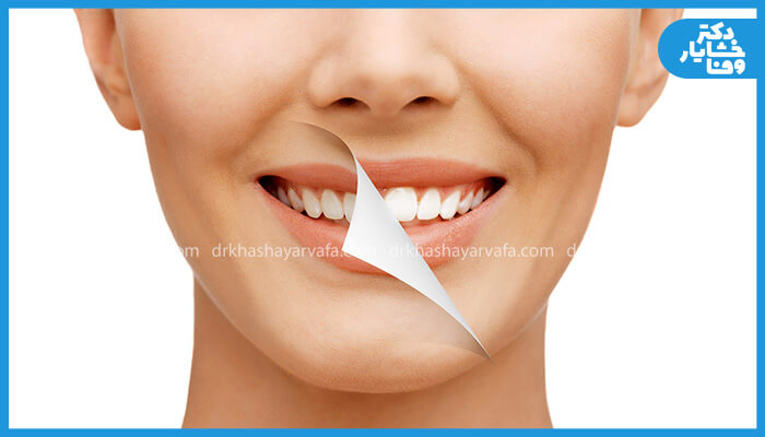 لبخند یک زن که نیمی از آن نشاندهنده لبخند قبل و نیم دیگر آن نشاندهنده لبخند پس از اصلاح طرح لبخند است.