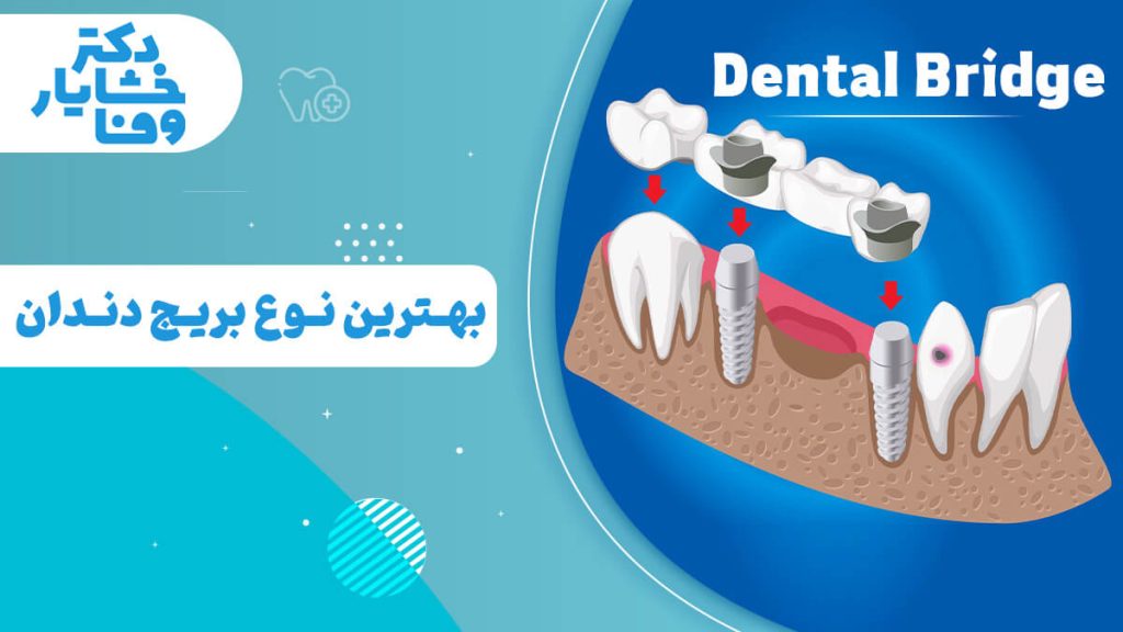 تصویر مقایسه ای بریج دندانی، با تمرکز بر بریج متکی بر ایمپلنت، و تاج دندان، که به سوال بهترین نوع بریج دندان است.