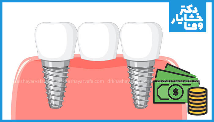  تصویر نشان دهنده بریج دندانی متکی بر ایمپلنت با نمادهای پول (دلار و سکه) است که هزینه و قیمت انواع بریج دندان را نشان می دهد.