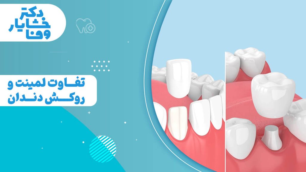 تفاوت بین لمینت دندان و روکش دندان با مدل‌های سه‌ بعدی