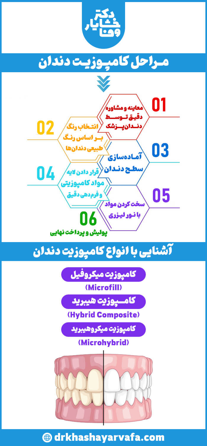 اینفوگرافیکی که مراحل انجام کامپوزیت دندان و انواع مختلف مواد کامپوزیت شامل میکروفیل، هیبرید و میکروهیبرید را نشان می‌دهد.