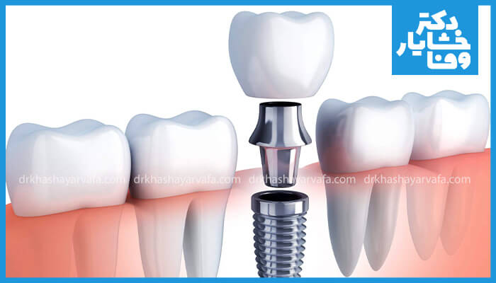 اجزای یک ایمپلنت دندان شامل فیکسچر، اباتمنت و روکش دندان