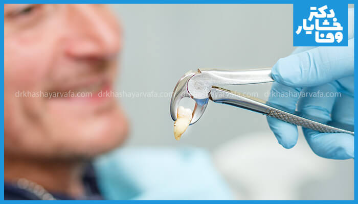 نمای نزدیک فورسپس حاوی دندان کشیده شده، با پس زمینه محو بیمار است.