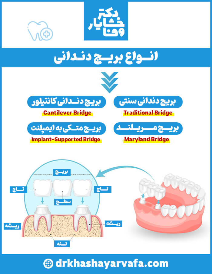 اینفوگرافیک جامع در مورد انواع بریج دندانی شامل بریج سنتی، بریج کانتیلور، بریج مریلند و بریج متکی بر ایمپلنت، همراه با شماتیک اجزای بریج دندان.