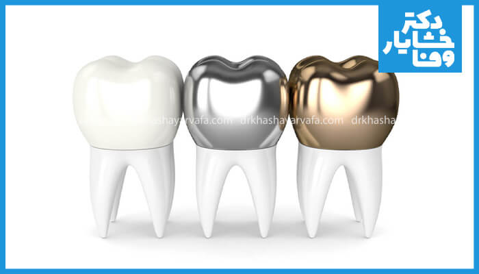 تصویری از انواع روکش‌های دندان شامل سرامیکی، فلزی و طلا