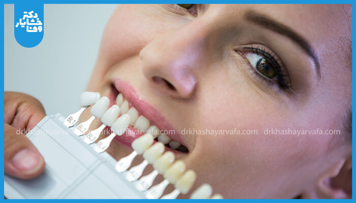 دست‌های یک دندانپزشک با دستکش که راهنمای رنگ دندان را در کنار دهان باز بیمار نگه داشته است تا رنگ ایده‌آل برای روکش کامپوزیت را انتخاب کند.