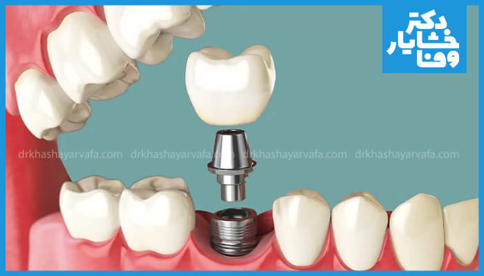 تصویر نمای نزدیک از ایمپلنت دندان کاشته شده در فک، شامل پایه (فیکسچر)، اباتمنت و روکش نهایی که به صورت یکپارچه نصب شده‌اند.