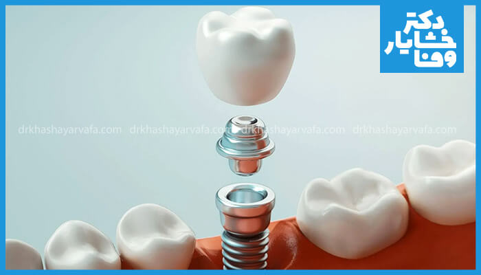 تصویر نمای نزدیک اجزای ایمپلنت دندان شامل پایه، اباتمنت و روکش که از هم جدا شده‌اند، نشان‌دهنده نحوه قرارگیری و مونتاژ آنها در فک