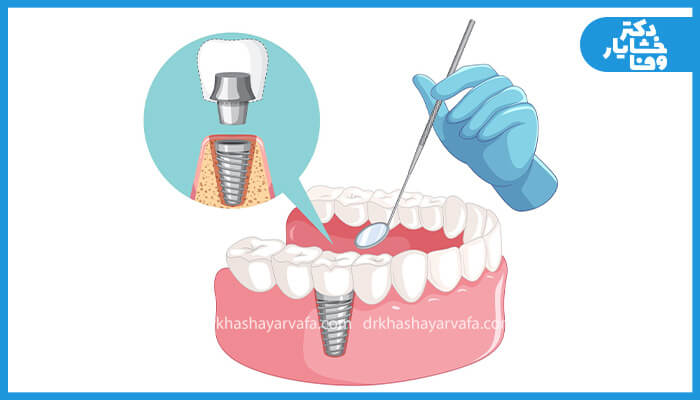 تصویر کارتونی از فک و دندان‌ها که یک ایمپلنت کاشته شده را نشان می‌دهد، همراه با ابزار دندانپزشکی (آینه دهانی) و یک نمای بزرگنمایی شده از اجزای ایمپلنت.