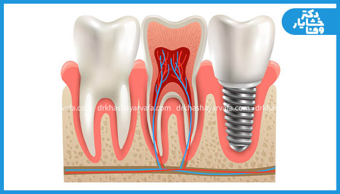 تصویر گرافیکی مقایسه‌ای از ساختار یک دندان طبیعی (با ریشه و عصب) در کنار یک ایمپلنت دندان، که هر دو در داخل لثه و استخوان فک قرار دارند.