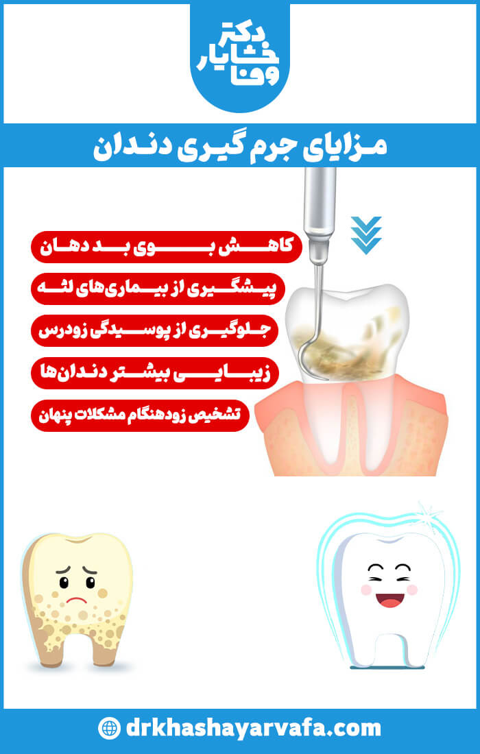مزایای جرم گیری دندان