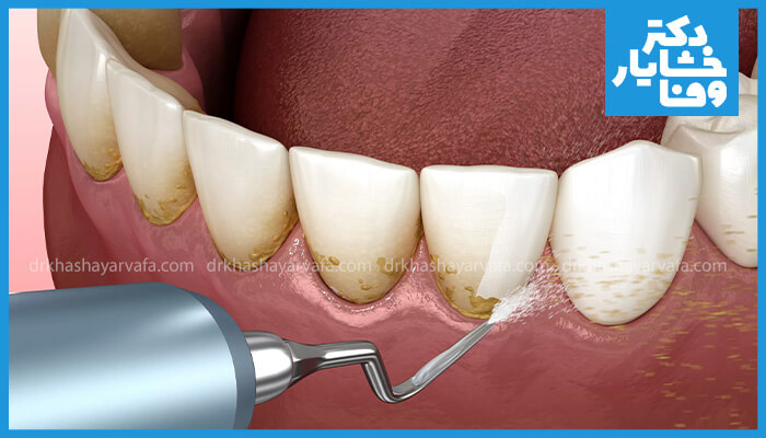 تصویر سه‌بعدی از فرآیند جرم‌گیری دندان، نشان‌دهنده تجمع جرم روی دندان‌ها و ابزار دندانپزشکی که در حال پاکسازی جرم با پاشش آب است.