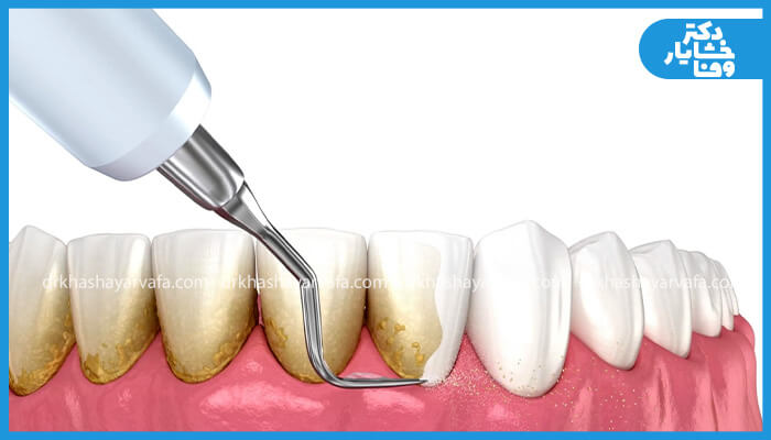 فرآیند جرمگیری دندان